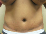 Tummy Tuck