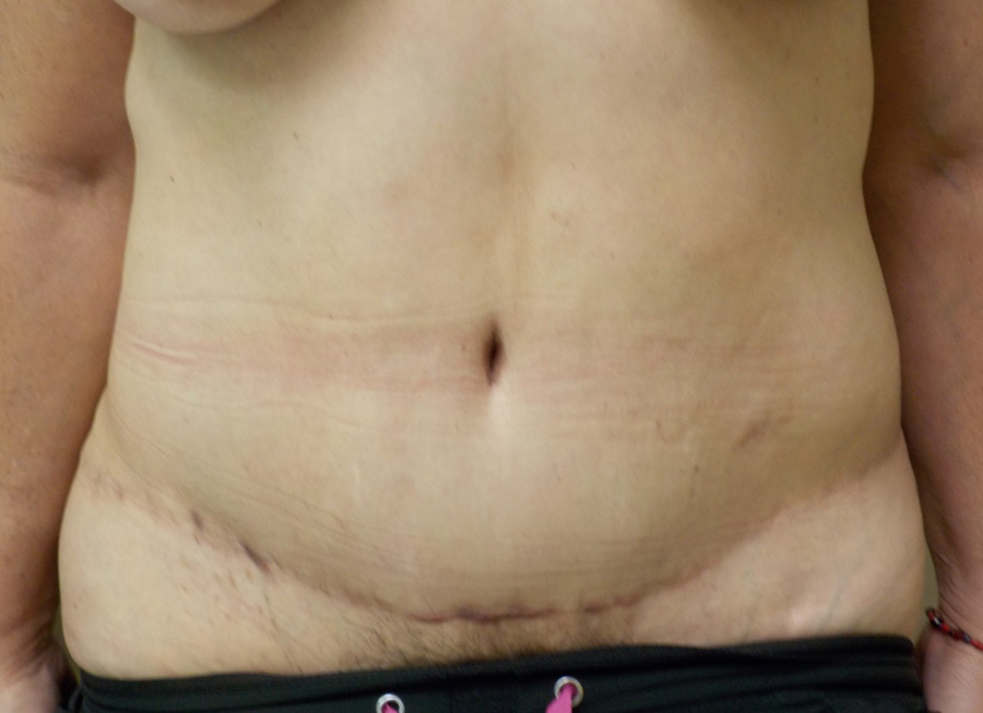 Tummy Tuck