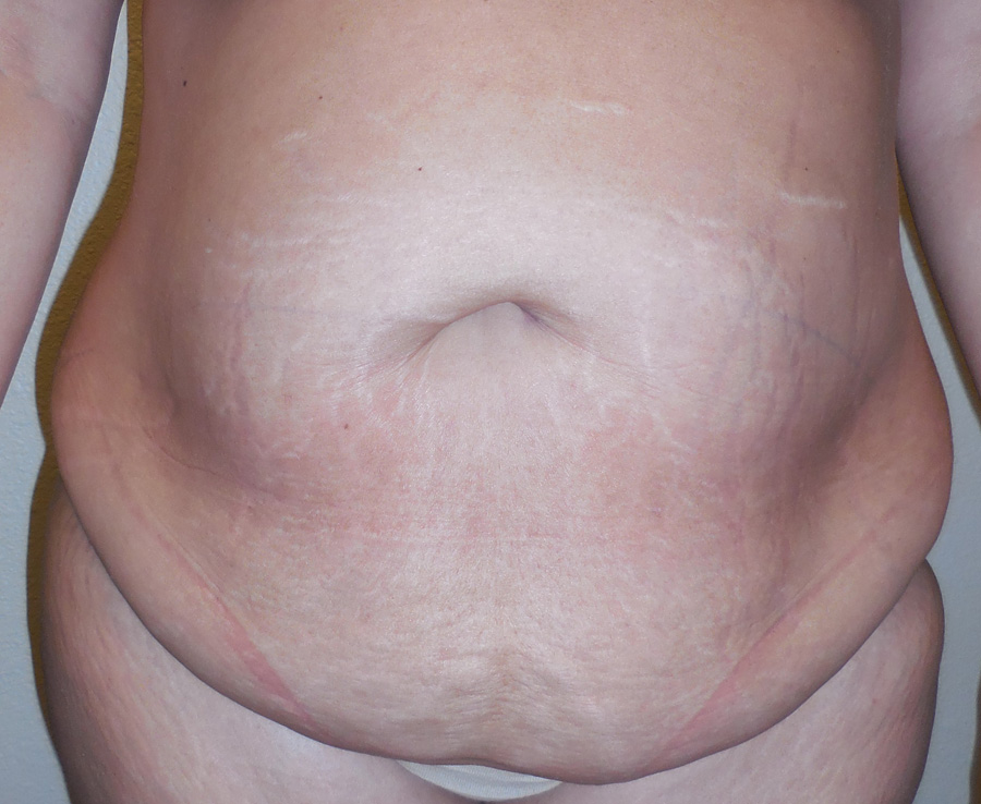 Tummy Tuck