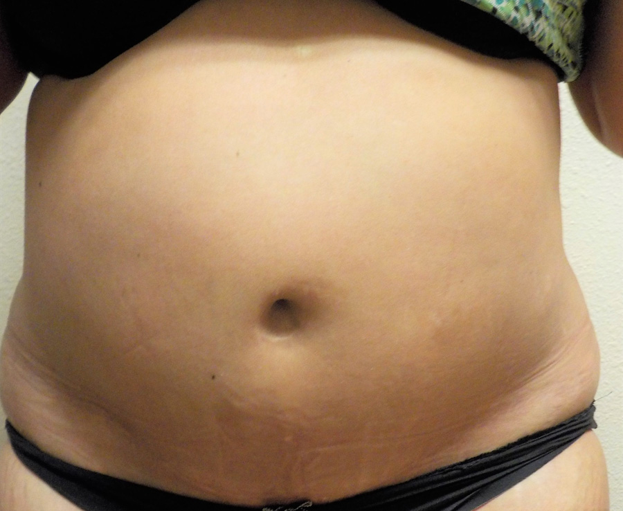 Tummy Tuck