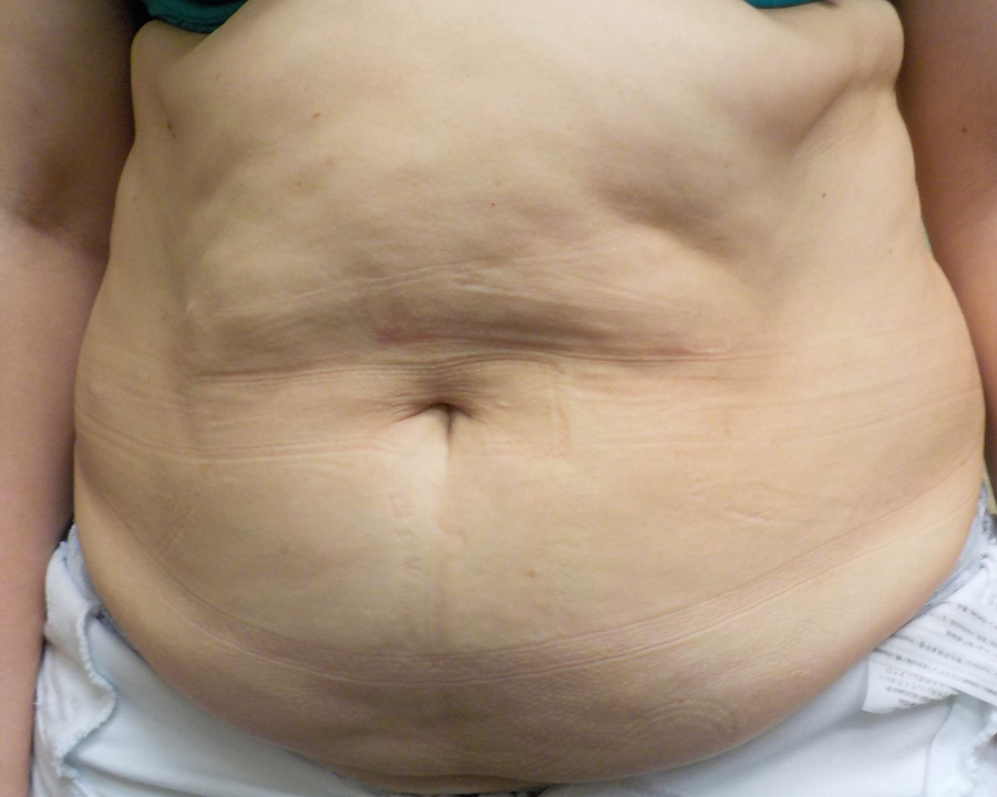 Tummy Tuck