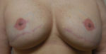 Nipple Sparing Mastectomies & Reconstruction
