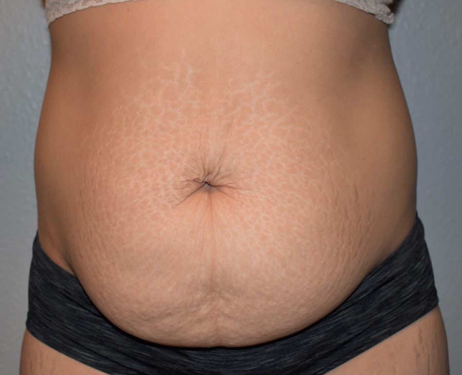 Tummy Tuck