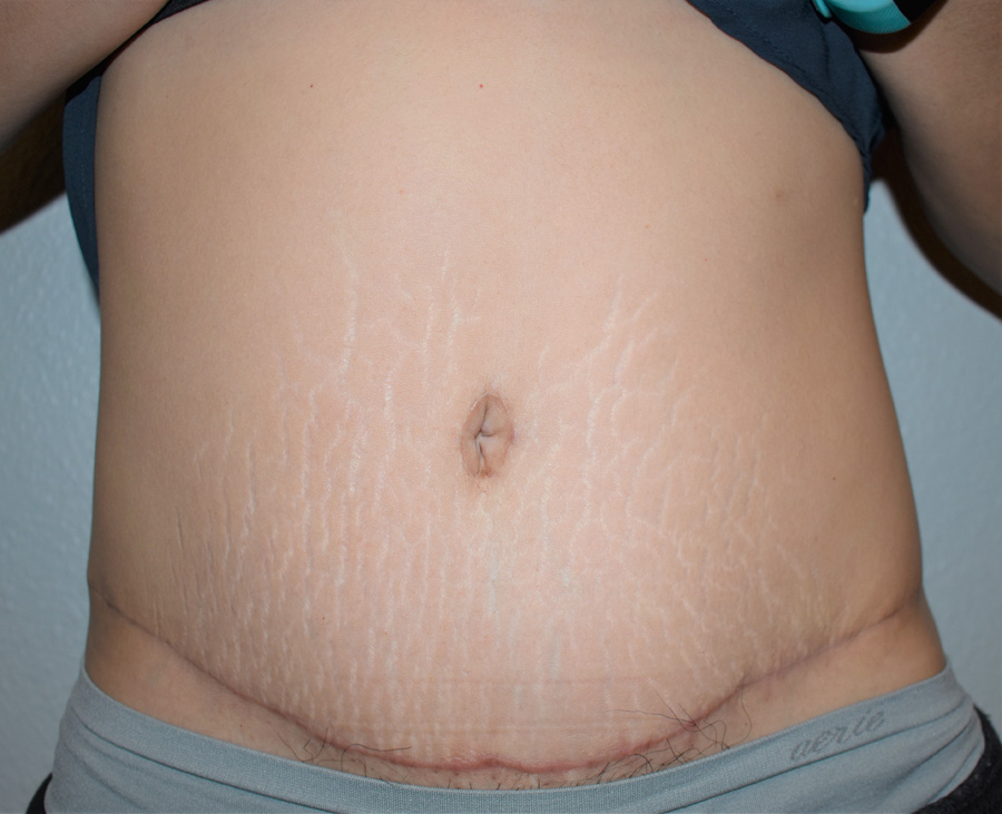 Tummy Tuck