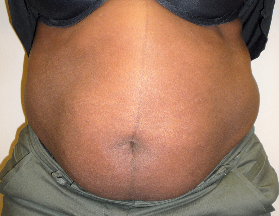 Tummy Tuck