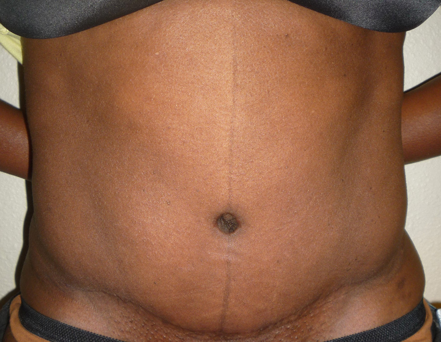 Tummy Tuck