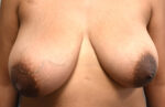 Breast Lift