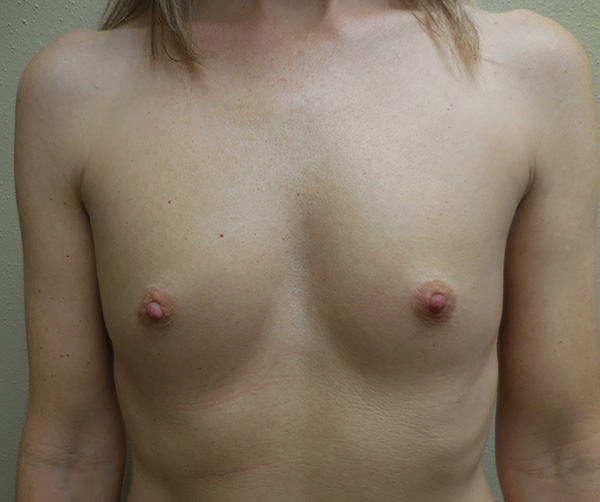 Breast Augmentation