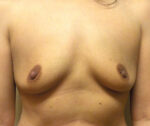 Breast Augmentation