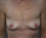 Breast Augmentation