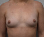 Breast Augmentation