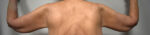 Brachioplasty