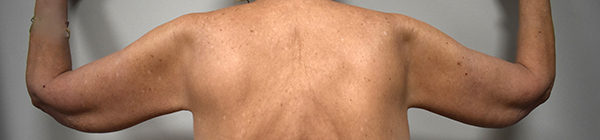 Brachioplasty