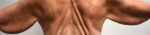 Brachioplasty