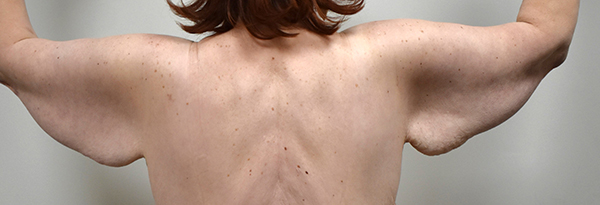 Brachioplasty