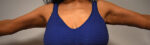 Brachioplasty