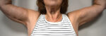 Brachioplasty