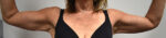 Brachioplasty