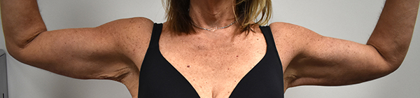 Brachioplasty