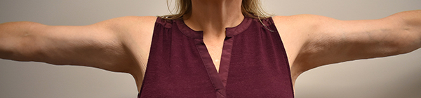Brachioplasty