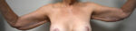Brachioplasty