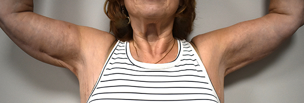 Brachioplasty