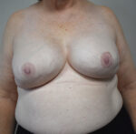 Breast Reconstruction