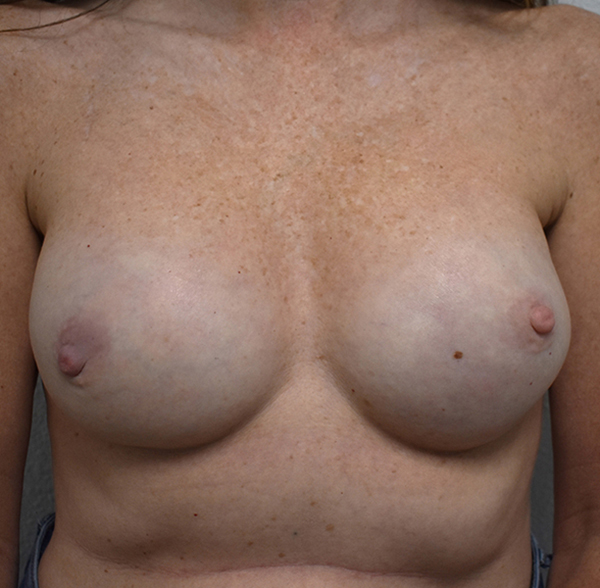 front-view-after-breast-reconstruction Breast Reconstruction
