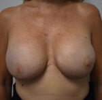 Breast Reconstruction