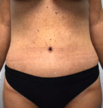 Tummy Tuck
