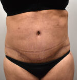 Tummy Tuck