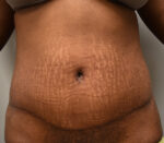Tummy Tuck