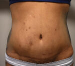 Tummy Tuck