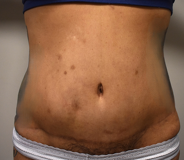 Tummy Tuck