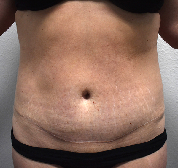 front-view-after-tummy-tuck Tummy Tuck