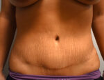 Tummy Tuck