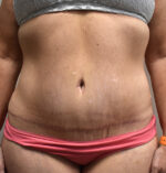 Tummy Tuck