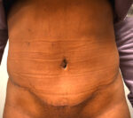 Tummy Tuck