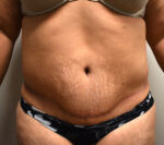 Tummy Tuck