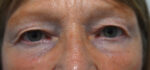 Blepharoplasty