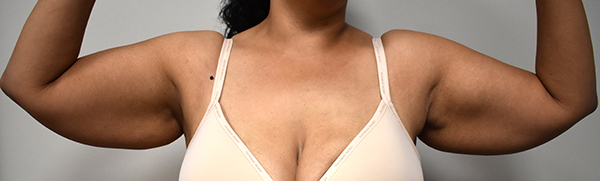 front-view-before-brachioplasty Brachioplasty