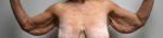 Brachioplasty