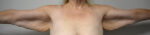 Brachioplasty