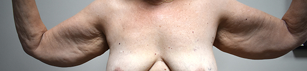 Brachioplasty