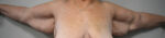 Brachioplasty