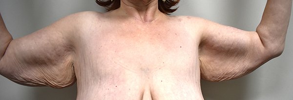 Brachioplasty