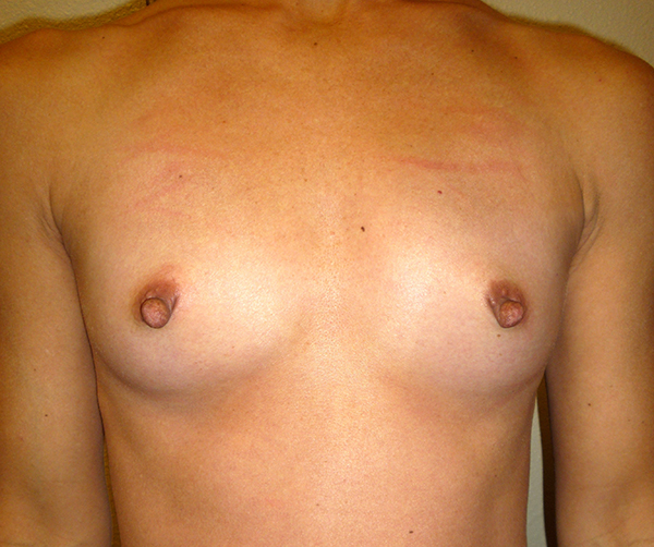 front-view-before-breast-augmentation Breast Augmentation
