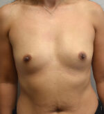 Breast Augmentation