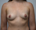 Breast Augmentation