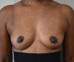 Breast Augmentation